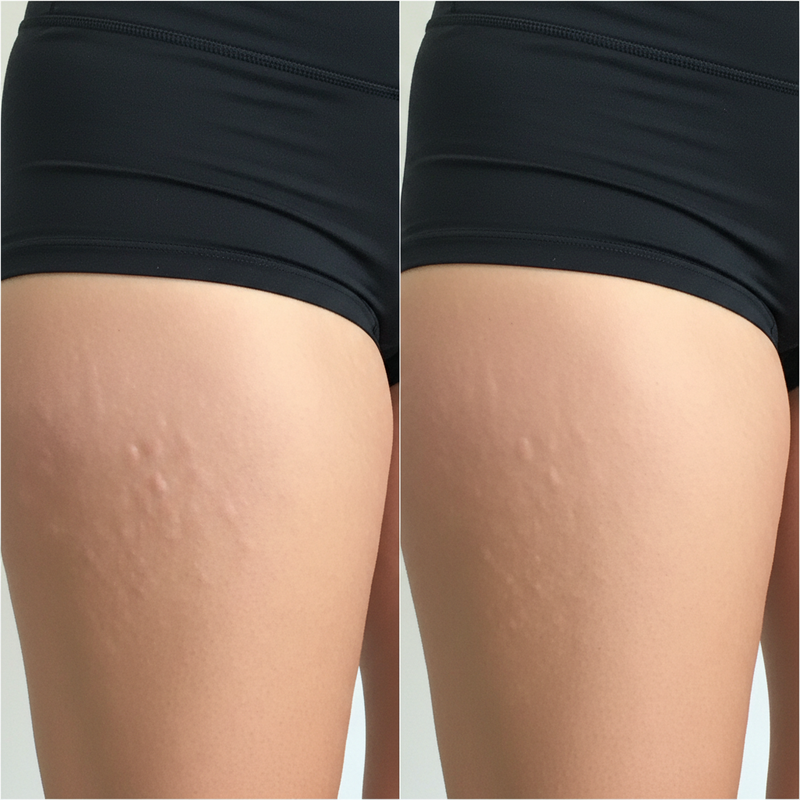 Before/After UGC - Thigh v4