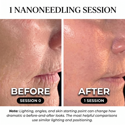 Sylairé Nano Precision Skin Renewal kit